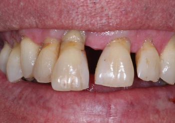 Before Dental Implants in Walsall
