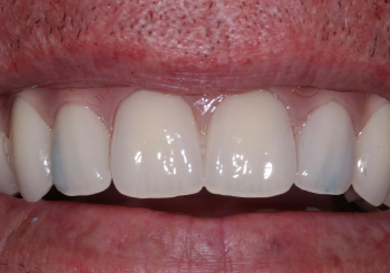 After Dental Implants in Walsall