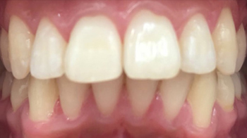 Post-op Dental Braces in Walsall Birmingham