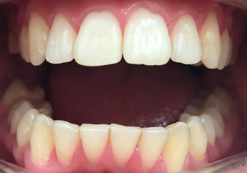 Post-op Orthodontics in Walsall Birmingham