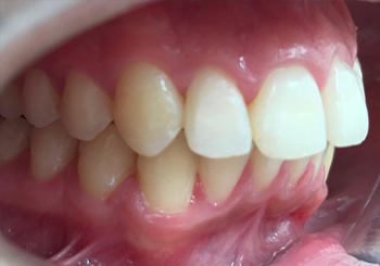 Post-op Teeth Straightening in Walsall Birmingham