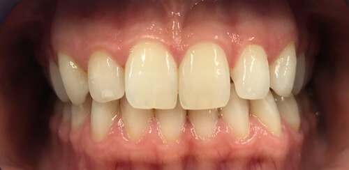 After Teeth Whitening at Premire Dental Care